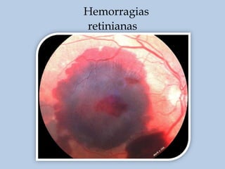 Hemorragias
retinianas

 
