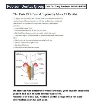 Mesa az dental implant parts dentist dr. gary robison