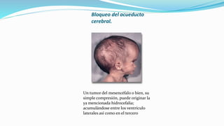 Bloqueo del acueducto
cerebral.
Un tumor del mesencéfalo o bien, su
simple compresión, puede originar la
ya mencionada hidrocefalia;
acumulándose entre los ventrículo
laterales así como en el tercero
 