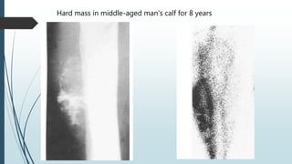 Hard mass in middle-aged man’s calf for 8 years
 