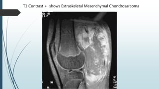 T1 Contrast + shows Extraskeletal Mesenchymal Chondrosarcoma
 