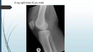 X-ray right knee 25 yrs. male
 