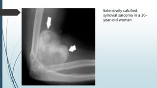 Extensively calcified
synovial sarcoma in a 36-
year-old woman
 