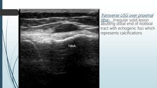 Transverse USG over proximal
tibia- Irregular solid lesion
abutting distal end of iliotibial
tract with echogenic foci which
represents calcifications
 