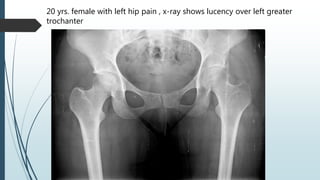 20 yrs. female with left hip pain , x-ray shows lucency over left greater
trochanter
 