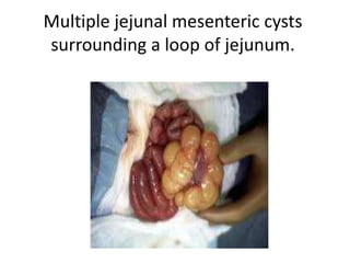 Multiple jejunal mesenteric cysts
surrounding a loop of jejunum.
 