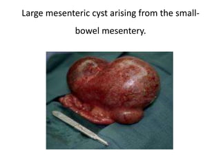 Large mesenteric cyst arising from the small-
bowel mesentery.
 
