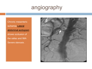 angiography
Chronic mesenteric
ischemia Lateral
abdominal aortogram
shows occlusion of
the celiac and IMA
Severe stenosis .
 