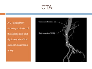 CTA
A CT angiogram
showing occlusion of
the coeliac axis and
tight stenosis of the
superior mesenteric
artery
 