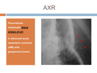 AXR
Pneumatosis
intestinalis (black
stripes of air)
in advanced acute
mesenteric ischemia
(AMI) with
gangrenous bowel.
 