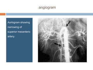 angiogram
Aortogram showing
narrowing of
superior mesenteric
artery.
 