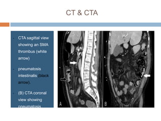 CT & CTA
• CTA sagittal view
showing an SMA
thrombus (white
arrow)
• pneumatosis
intestinalis (black
arrow).
• (B) CTA coronal
view showing
pneumatosis
 