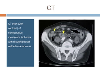 CT
CT scan (with
contrast) of
nonocclusive
mesenteric ischemia
with resulting bowel
wall edema (arrows).
 