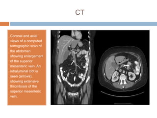 CT
Coronal and axial
views of a computed
tomographic scan of
the abdomen
showing enlargement
of the superior
mesenteric vein. An
intraluminal clot is
seen (arrows),
showing extensive
thrombosis of the
superior mesenteric
vein.
 