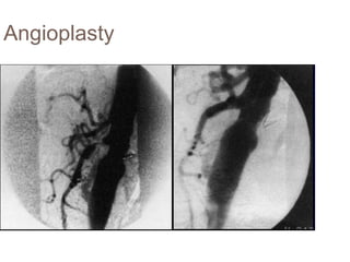 Angioplasty
 