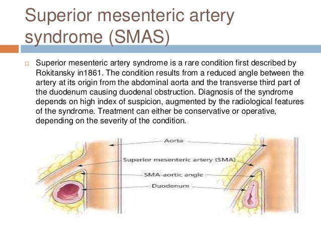 sma syndrome