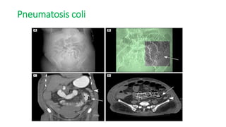 Pneumatosis coli
 