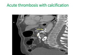Acute thrombosis with calcification
 