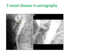 3 vessel disease in aortography
 