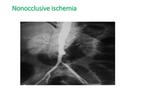 Nonocclusive ischemia
 