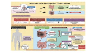 Mesenteric Ischemia 