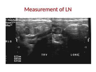 Measurement of LN
 