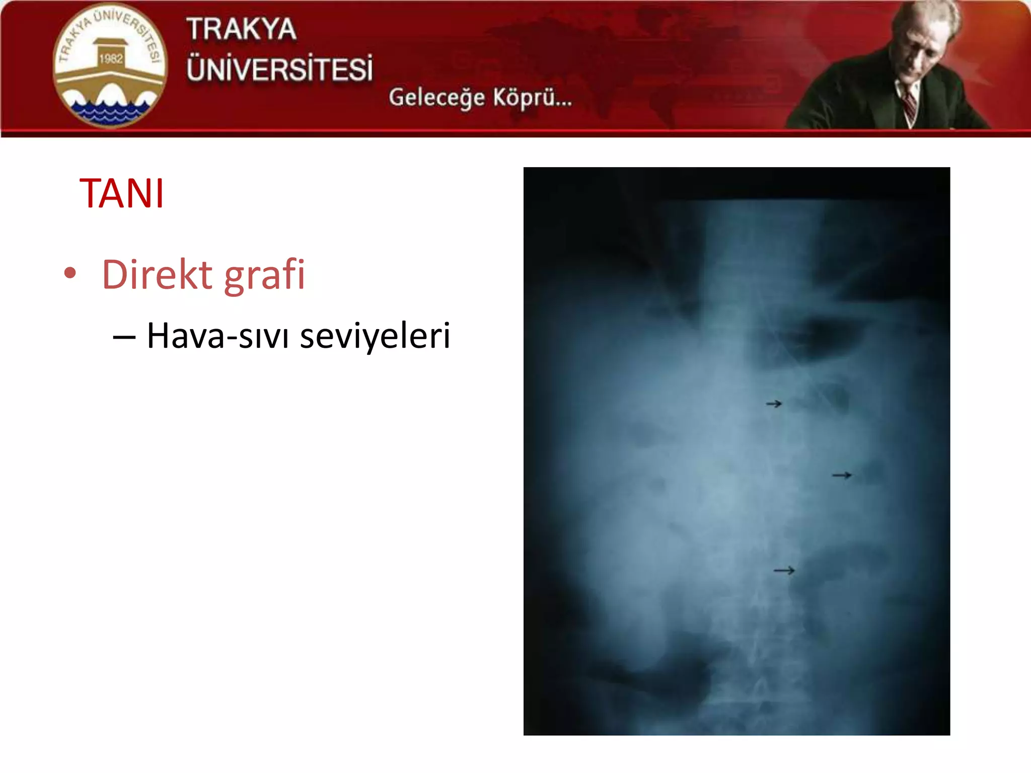 TANI
• Direkt grafi
  – Hava-sıvı seviyeleri
 