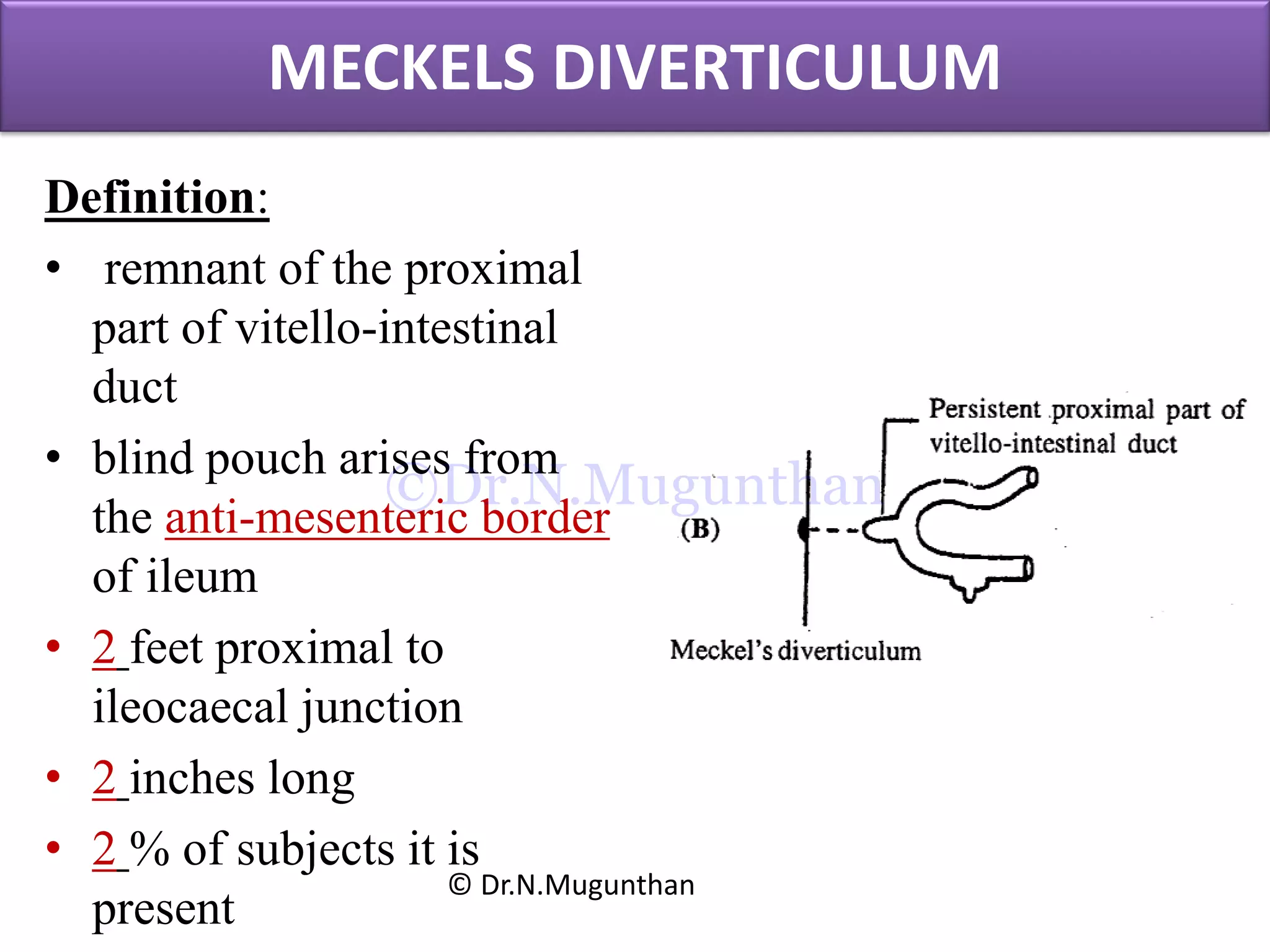 MECKELS DIVERTICULUM
Definition:
• remnant of the proximal
part of vitello-intestinal
duct
• blind pouch arises from
the anti-mesenteric border
of ileum
• 2 feet proximal to
ileocaecal junction
• 2 inches long
• 2 % of subjects it is
present
© Dr.N.Mugunthan
©Dr.N.Mugunthan
 