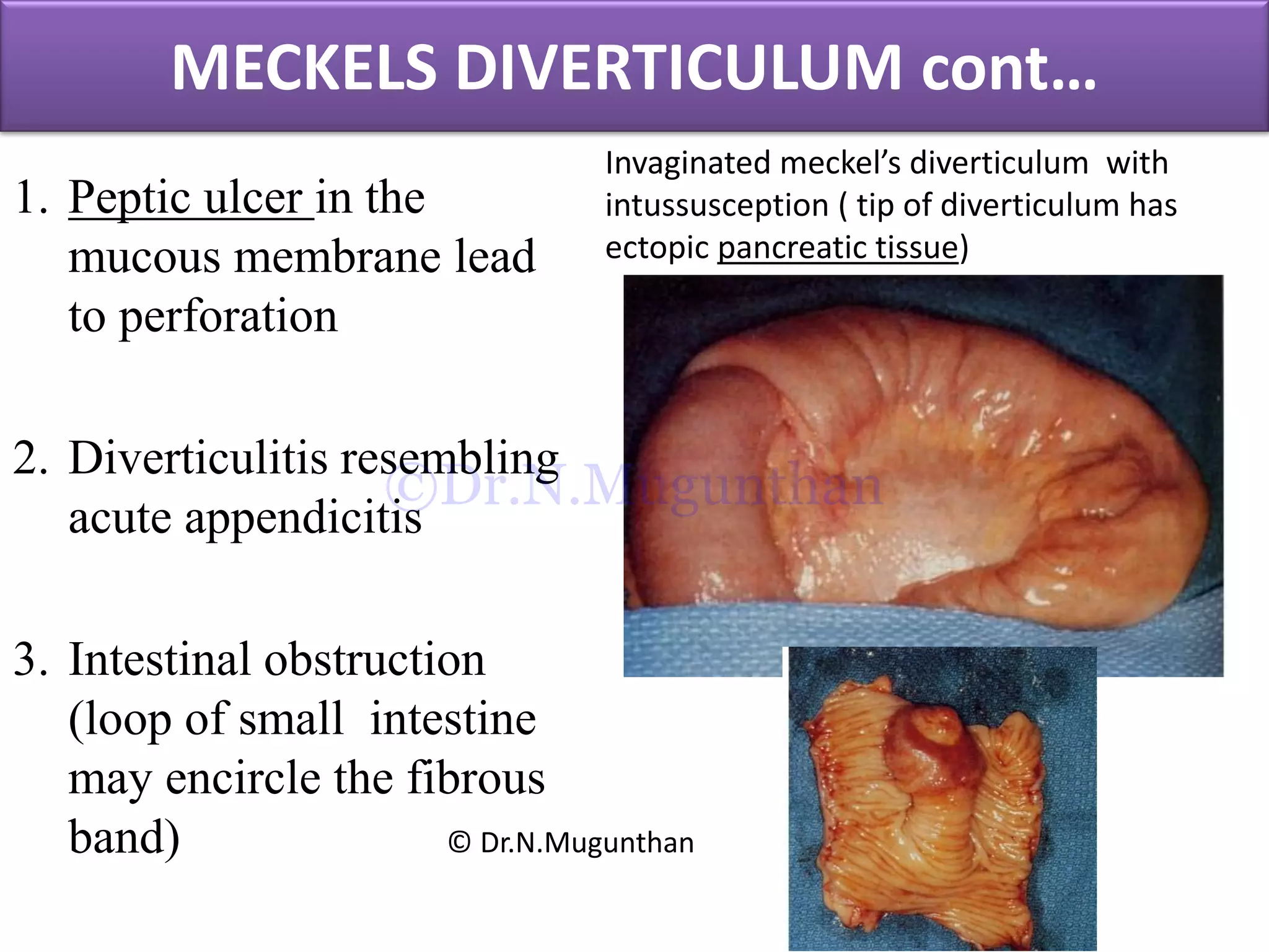 MECKELS DIVERTICULUM cont…
1. Peptic ulcer in the
mucous membrane lead
to perforation
2. Diverticulitis resembling
acute appendicitis
3. Intestinal obstruction
(loop of small intestine
may encircle the fibrous
band)
Invaginated meckel’s diverticulum with
intussusception ( tip of diverticulum has
ectopic pancreatic tissue)
© Dr.N.Mugunthan
©Dr.N.Mugunthan
 
