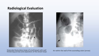 Radiological Evaluation
Distended featureless loops of small bowel with wall
thickening (arrow) and separation of the bowel loops
Air within the wall of the ascending colon (arrow)
 