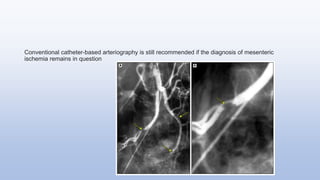 Conventional catheter-based arteriography is still recommended if the diagnosis of mesenteric
ischemia remains in question
 