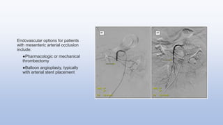 Endovascular options for patients
with mesenteric arterial occlusion
include:
●Pharmacologic or mechanical
thrombectomy
●Balloon angioplasty, typically
with arterial stent placement
 