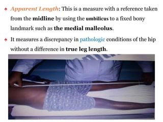 ♠ Apparent Length: This is a measure with a reference taken
from the midline by using the umbilicus to a fixed bony
landmark such as the medial malleolus.
♠ It measures a discrepancy in pathologic conditions of the hip
without a difference in true leg length.
33
 