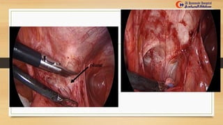 Chronic abdominal pain due to mesh erosion into the intestine.pptx