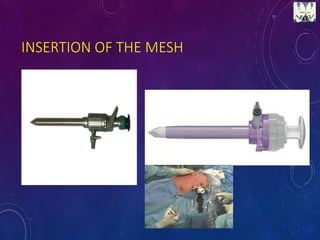 INSERTION OF THE MESH
 