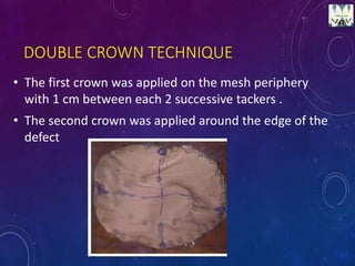 DOUBLE CROWN TECHNIQUE
• The first crown was applied on the mesh periphery
with 1 cm between each 2 successive tackers .
• The second crown was applied around the edge of the
defect
 