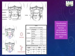Classification
of incisional
hernias
according to
the European
Hernia Society
2017
 