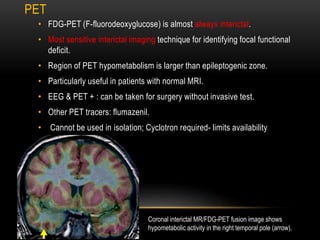 PET
• FDG-PET (F-fluorodeoxyglucose) is almost always interictal.
• Most sensitive interictal imaging technique for identifying focal functional
deficit.
• Region of PET hypometabolism is larger than epileptogenic zone.
• Particularly useful in patients with normal MRI.
• EEG & PET + : can be taken for surgery without invasive test.
• Other PET tracers: flumazenil.
• Cannot be used in isolation; Cyclotron required- limits availability
Coronal interictal MR/FDG-PET fusion image shows
hypometabolic activity in the right temporal pole (arrow).
 