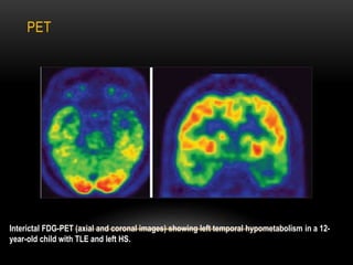 Interictal FDG-PET (axial and coronal images) showing left temporal hypometabolism in a 12-
year-old child with TLE and left HS.
PET
 
