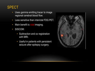 SPECT
• Uses gamma emitting tracer to image
regional cerebral blood flow.
• Less sensitive than interictal FDG PET.
• Main benefit is ictal imaging.
• SISCOM:
• Subtraction and co registration
with MRI.
• Useful in patients with persistent
seizure after epilepsy surgery.
 