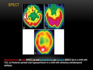 SPECT
Hyperperfusion on ictal SPECT (a) and hypoperfusion on interictal SPECT (b) in a child with
TLE. (c) Posterior parietal ictal hyperperfusion in a child with refractory extratemporal
epilepsy.
 
