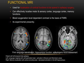 FUNCTIONAL MRI
• Used for localisation of cortical functions to be spared in epilepsy surgery.
• Can effectively localise motor & sensory cortex, language cortex, memory
functions.
• Blood oxygenation level dependent contrast is the basis of FMRI.
• Its experimental presently.
Patient with left temporal lobe epilepsy.
Left: Language mapping with verb generation task - activation in Broca’s and Wernicke’s areas.
Right: Memory localization with picture encoding task - decreased activation in the left hippocampus.
Fmri- language lateralization, hippocampus function, epileptogenic focus assessment
 
