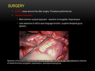 SURGERY
• 60-80% cases seizure free after surgery. Procedure performed are
• Temporal lobectomy.
• Most common surgical approach : resection of amygdala, hippocampus.
• Less extensive on left to save language function.( superior temporal gyrus
spared )
Resection of the anterior temporal lobe (~4.5 cm on left side, ~5.5 cm on right side) followed by resection
of mesial structures (amygdala, hippocampus, parahippocampal gyrus)
 