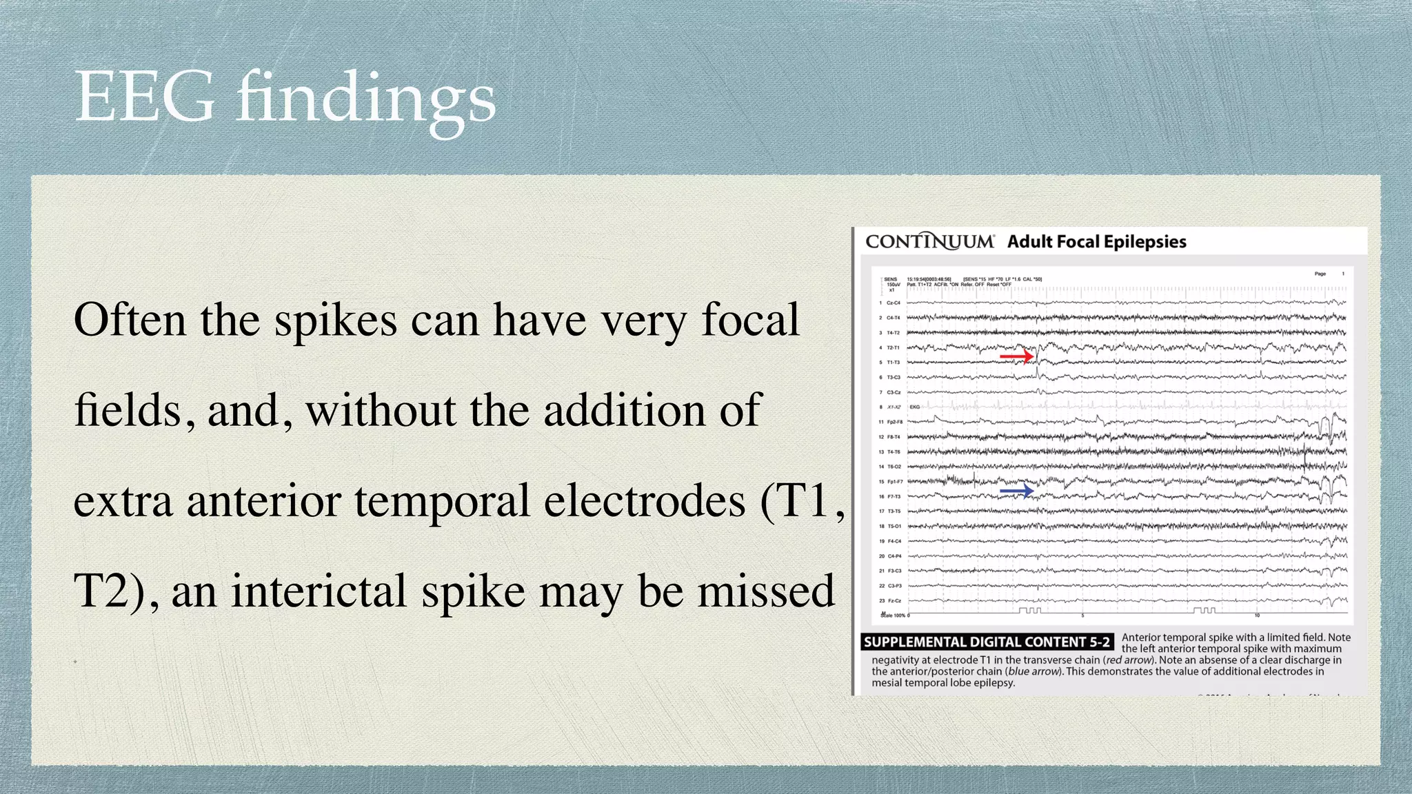 EEG
fi
ndings
Often the spikes can have very focal
fi
elds, and, without the addition of
extra anterior temporal electrodes (T1,
T2), an interictal spike may be missed
 