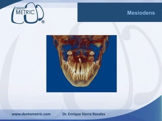 www.dentometric.com Dr. Enrique Sierra Rosales
Mesiodens
 
