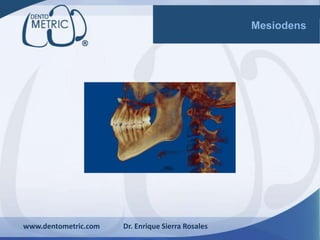 www.dentometric.com Dr. Enrique Sierra Rosales
Mesiodens
 