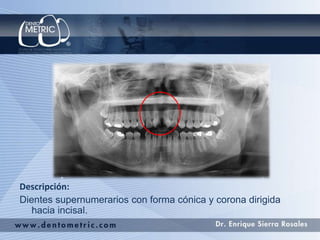 Descripción:
Dientes supernumerarios con forma cónica y corona dirigida
hacia incisal.