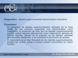 Diagnostico: dientes supernumerarios denominados mesiodens.
Comentario:
La presencia de dientes supernumerarios ubicados en la línea
media de los incisivos superiores son denominados como
mesiodens, la presencia de este tipo de dientes supernumerarios
pueden causar algunas alteraciones como malposición dentaria de
dientes vecinos, retraso en la erupción de los dientes centrales
permanentes, diastemas y en ocasiones la formación de quistes.
El mesiodens es el mas frecuente de los dientes supernumerarios,
pueden ser únicos, pares e incluso pueden encontrase en mayor
numero.