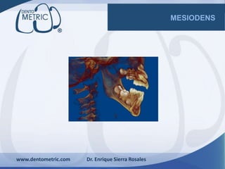 MESIODENS
www.dentometric.com Dr. Enrique Sierra Rosales
 