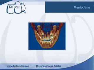 www.dentometric.com Dr. Enrique Sierra Rosales
Mesiodens